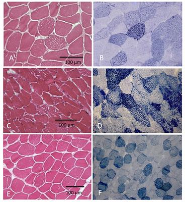 Diagnostic Challenges in Late Onset Multiple Acyl-CoA Dehydrogenase Deficiency: Clinical, Morphological, and Genetic Aspects